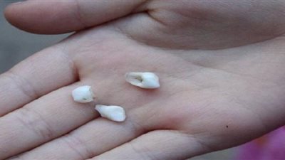 تفسير حلم «سقوط الأسنان» في اليد للعزباء والمطلقة والحامل 