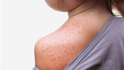 مع ارتفاع درجات الحرارة.. 5 نصائح لوقاية طفلك من حمو النيل