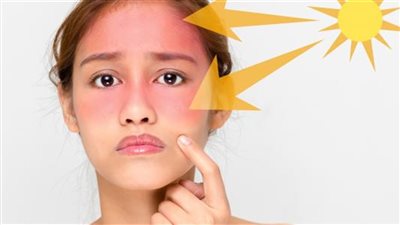  3 وصفات طبيعية لعلاج حروق الشمس.. تغنيك عن كريمات التفتيح