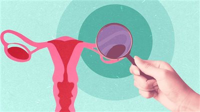 6 مؤشرات للإصابة بمرض سرطان المبيض.. احذري تجاهلها