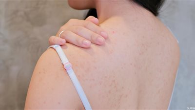 في حر الصيف.. 3 طرق طبيعية للتخلص من حب الشباب في الكتف