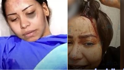 «دمائها تسيل ».. أول صورة لـ شيرين عبد الوهاب بعد اعتداء حسام حبيب عليها