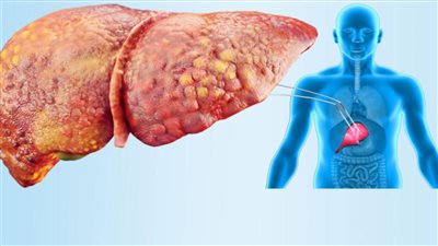 أطعمة ونصائح تحميك من مرض الكبد الدهني
