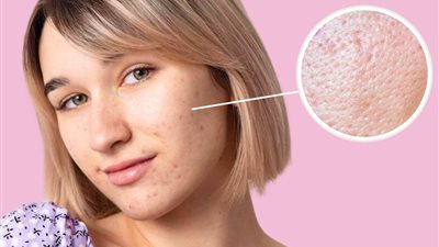نصائح هامة لعلاج مشكلة مسام البشرة الواسعة لوجه صافي 