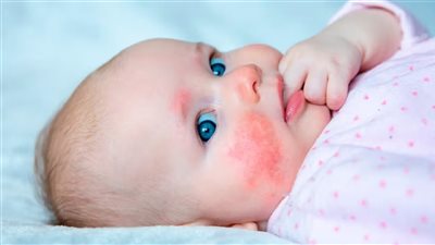 للأمهات الجدد.. متى تبدأ أعراض حساسية الألبان في الظهور على الطفل؟