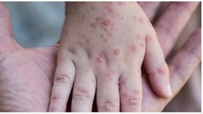 الأعراض والوقاية من «جدري القرود».. وهل يوجد تطيعم للمرض؟