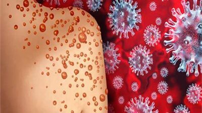 باكستان تسجل أول حالة إصابة بفيروس جدري القرود والصحة العالمية تعيش حالة قلق