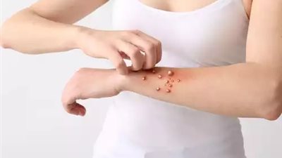 بعد تفشي جدري القرود.. 6 تدابير غذائية يجب الحرص عليها للوقاية 