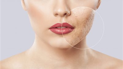 وصفات طبيعية فعالة لعلاج ندبات حب الشباب