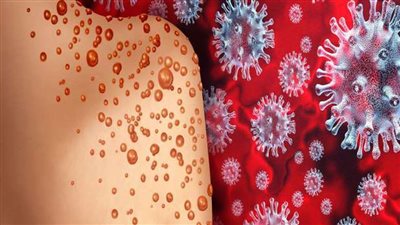 جدري القرود.. كيف تنتقل العدوى وما هي مدة العزل المنزلي للمصابين؟