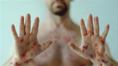 المغرب تعلن عن أول حالة مصابة بجدري القرود.. والصحة على أهبة الاستعداد 