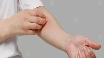 أسباب مرض التهاب الجلد الدهني وأعراضه وطرق علاجه