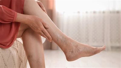 الصحة تكشف 4 طرق للوقاية من الجلطات الوريدية