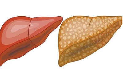  كل ما تريد معرفته عن الكبد الدهني في الأطفال.. العلاج والوقاية