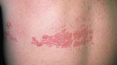 الحزام الناري.. من هي الفئة الأكثر عرضة للإصابة بالمرض؟