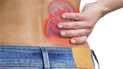 4 علاجات طبيعية للتخلص من حصوات الكلى