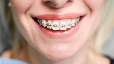 استشاري «بالقومي للبحوث» تقدم 3 إرشادات ضرورية بعد تركيب تقويم الأسنان