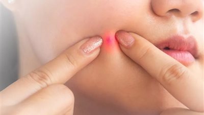 بدون أدوية أو تكلفة.. طريقة استخدام الثوم لعلاج حب الشباب