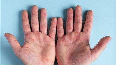 «الدواء المصرية» تصدر تنبيهًا مهمًا لمرضى اليد والقدم والفم