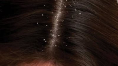 عادات خاطئة تؤدي إلى إصابتك بقشرة الشعر