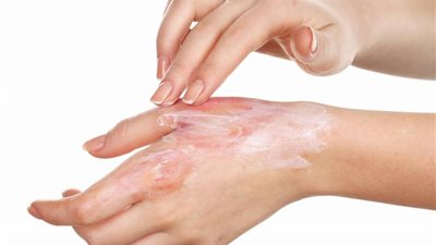 الصحة تكشف 4 حالات حروق يجب عند حدوثها زيارة المستشفى فورًا