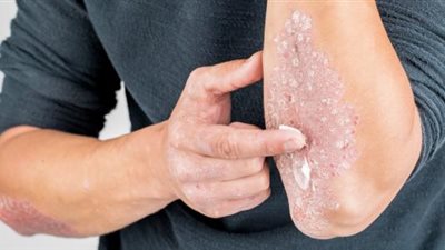 في فصل الشتاء.. 4 نصائح يجب فعلها لمنع تهيج الصدفية 