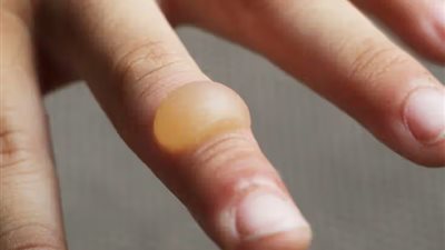 احذري من فتح الفقاعات الناتجة عن الحروق لهذا السبب