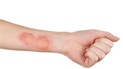 وزارة الصحة : 5 خطوات مهمة لإسعاف الشخص المصاب بالحروق