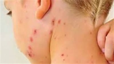 تفشي الحصبة في تكساس الأمريكية ووفاة أول طفل.. إليك أعراضها