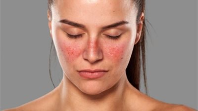 في يومها العالمي..هيئة الدواء المصرية تقدم بعض النصائح للتعامل مع الذئبة الحمراء