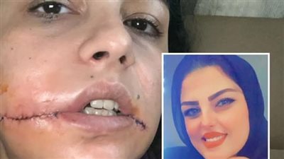 منى تستغيث: وجهي شُوّه لأنني قلت لا… فأين حقي؟