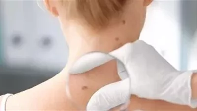 هيئة الدواء تكشف نصائح للحماية من أشعة الشمس وسرطان الجلد في الصيف