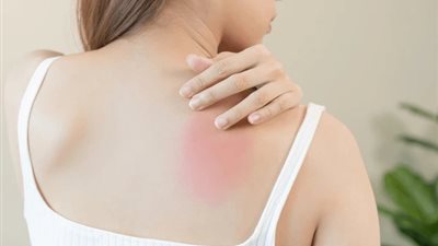 «القومي للبحوث» يكشف عن أمراض جلدية تصيب الطلاب في فترة الامتحانات