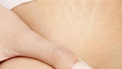 أفضل الطرق للتخلص من علامات التمدد والخطوط البيضاء فى الجسم