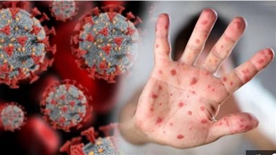 الصحة العالمية: أكثر من 6800 إصابة مؤكدة بجدري القرود و16 وفاة في مايو 2025