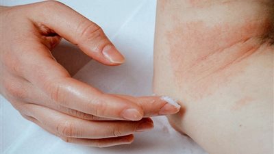 خلطات طبيعية للعناية بالبشرة المصابة بالأكزيما في الصيف