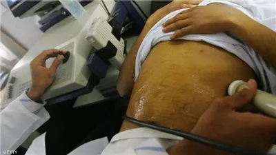 5 أعراض لتلف الكبد تظهر على مرضى ارتفاع ضغط الدم