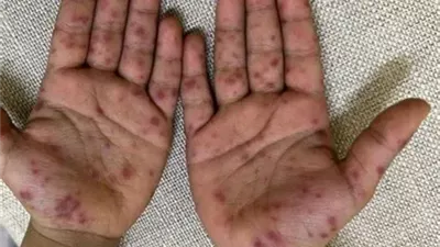 بعد انتشاره بين طلاب المدارس.. تعرفي على متلازمة اليد والقدم والفم