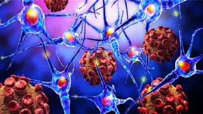 ظهور النمش والصداع دلالة على الإصابة بالورم الليفي عصبي