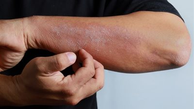 الصدفية مرض مزمن بأسباب نفسية ووراثية.. تعرّف على أبرز الأعراض وطرق العلاج الفعّالة