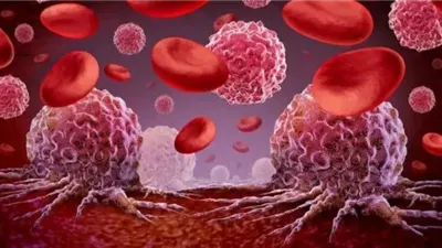 السعودية من الدول الأدنى عالميا في معدلات الإصابة بالسرطان