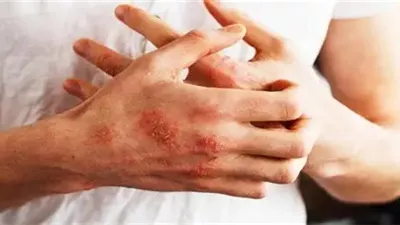 لتجنب الإلتهابات الناتجة عن مرض الصدفية.. إليكي 5 أطعمة للحد منها 