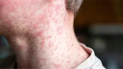 رعب في إسرائيل بعد تفشي الحصبة وإصابة الأطباء