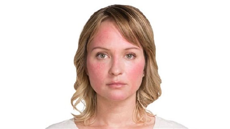 إحمرار الوجه