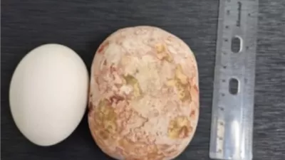 استخراج حصوة تزن كيلوجرامًا من مثانة رجل