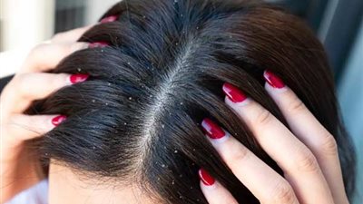 ودعي قشرة الشعر نهائيًا.. 6 حلول طبيعية من داخل منزلك 