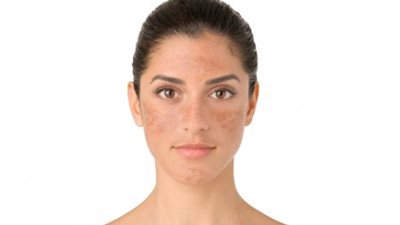 للحصول على بشرة نقية ومشرقة ...ماسكات طبيعية لعلاج التصبغات الجلدية  