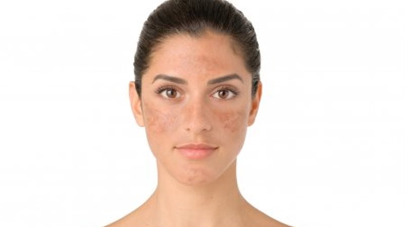 التصبغات الجلدية 