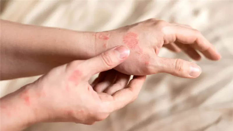 تفاقم الصدفية والإكزيما 