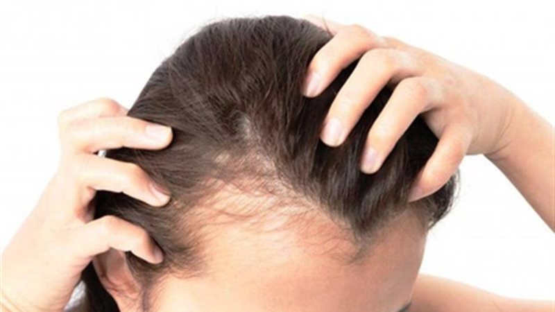 تساقط الشعر 